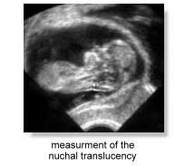 measurement of the nuchal translucency
